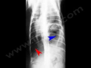 Accident de la rue (urgence vétérinaire vraie) chez un chat. La radiographie du thorax a permis de mettre en évidence un pneumothorax (flèche rouge) et une hernie diaphragmatique (flèche bleue).
